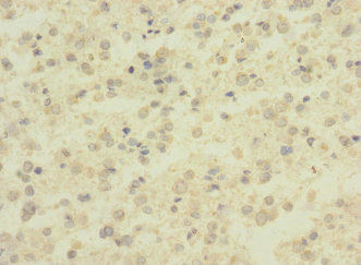 ADGRB1 / BAI1 Antibody - Immunohistochemistry of paraffin-embedded human glioma at dilution 1:100