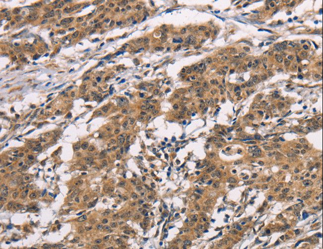 ADGRB1 / BAI1 Antibody - Immunohistochemistry of paraffin-embedded Human thyroid cancer using BAI1 Polyclonal Antibody at dilution of 1:40.
