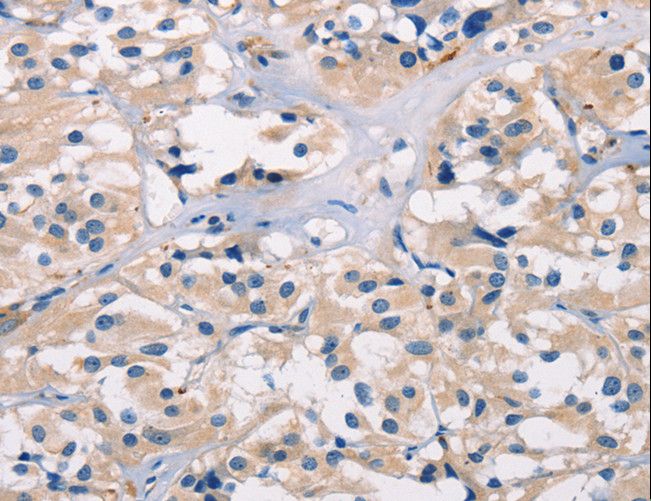ADGRB1 / BAI1 Antibody - Immunohistochemistry of paraffin-embedded Human thyroid cancer using BAI1 Polyclonal Antibody at dilution of 1:40.