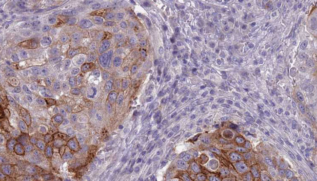 ADGRB1 / BAI1 Antibody - 1:100 staining human urothelial carcinoma tissue by IHC-P. The sample was formaldehyde fixed and a heat mediated antigen retrieval step in citrate buffer was performed. The sample was then blocked and incubated with the antibody for 1.5 hours at 22°C. An HRP conjugated goat anti-rabbit antibody was used as the secondary.