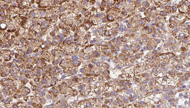 ADGRB2 / BAI2 Antibody - 1:100 staining human liver carcinoma tissues by IHC-P. The sample was formaldehyde fixed and a heat mediated antigen retrieval step in citrate buffer was performed. The sample was then blocked and incubated with the antibody for 1.5 hours at 22°C. An HRP conjugated goat anti-rabbit antibody was used as the secondary.