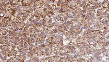ADGRB2 / BAI2 Antibody - 1:100 staining human liver carcinoma tissues by IHC-P. The sample was formaldehyde fixed and a heat mediated antigen retrieval step in citrate buffer was performed. The sample was then blocked and incubated with the antibody for 1.5 hours at 22°C. An HRP conjugated goat anti-rabbit antibody was used as the secondary.