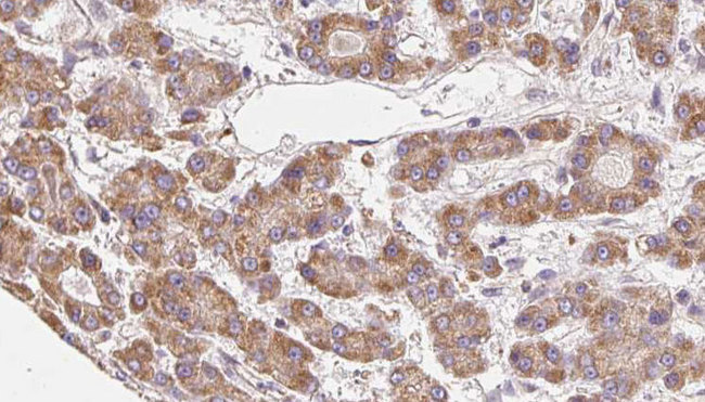 ADGRB3 / BAI3 Antibody - 1:100 staining human liver carcinoma tissues by IHC-P. The sample was formaldehyde fixed and a heat mediated antigen retrieval step in citrate buffer was performed. The sample was then blocked and incubated with the antibody for 1.5 hours at 22°C. An HRP conjugated goat anti-rabbit antibody was used as the secondary.