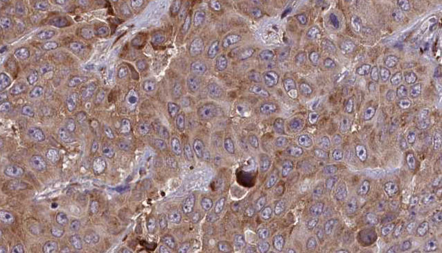 ADGRD1 / GPR133 Antibody - 1:100 staining human liver carcinoma tissues by IHC-P. The sample was formaldehyde fixed and a heat mediated antigen retrieval step in citrate buffer was performed. The sample was then blocked and incubated with the antibody for 1.5 hours at 22°C. An HRP conjugated goat anti-rabbit antibody was used as the secondary.