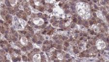 ADGRE1 / EMR1 Antibody - 1:100 staining human liver carcinoma tissues by IHC-P. The sample was formaldehyde fixed and a heat mediated antigen retrieval step in citrate buffer was performed. The sample was then blocked and incubated with the antibody for 1.5 hours at 22°C. An HRP conjugated goat anti-rabbit antibody was used as the secondary.