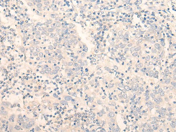 ADGRE3 / EMR3 Antibody - Immunohistochemistry of paraffin-embedded Human cervical cancer tissue  using ADGRE3 Polyclonal Antibody at dilution of 1:35(×200)