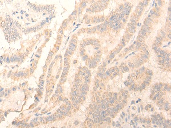 ADGRE3 / EMR3 Antibody - Immunohistochemistry of paraffin-embedded Human thyroid cancer tissue  using ADGRE3 Polyclonal Antibody at dilution of 1:35(×200)