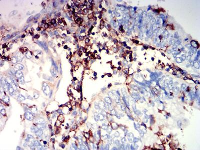 ADGRE5 / CD97 Antibody - Immunohistochemical analysis of paraffin-embedded endometrial cancer tissues using CD97 mouse mAb with DAB staining.