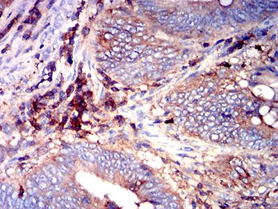 ADGRE5 / CD97 Antibody - Immunohistochemical analysis of paraffin-embedded rectum cancer tissues using CD97 mouse mAb with DAB staining.