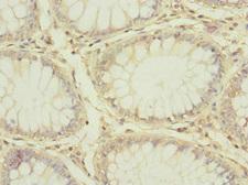 ADGRE5 / CD97 Antibody - Immunohistochemistry of paraffin-embedded human colon cancer at dilution 1:100