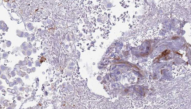 ADGRE5 / CD97 Antibody - 1:100 staining human urothelial carcinoma tissue by IHC-P. The sample was formaldehyde fixed and a heat mediated antigen retrieval step in citrate buffer was performed. The sample was then blocked and incubated with the antibody for 1.5 hours at 22°C. An HRP conjugated goat anti-rabbit antibody was used as the secondary.