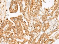 ADGRF1 / GPR110 Antibody - Immunohistochemistry of paraffin-embedded Human thyroid cancer tissue  using ADGRF1 Polyclonal Antibody at dilution of 1:25(×200)