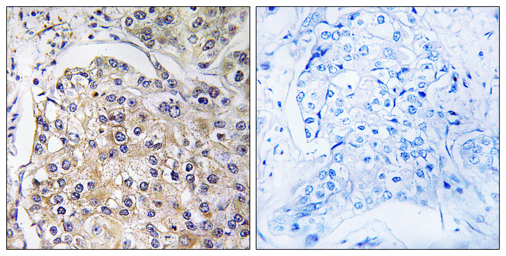 ADGRF5 / GPR116 Antibody - Immunohistochemistry analysis of paraffin-embedded human breast carcinoma tissue, using GPR116 Antibody. The picture on the right is blocked with the synthesized peptide.