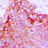 ADGRF5 / GPR116 Antibody - Immunohistochemical analysis of GPR116 staining in human breast cancer formalin fixed paraffin embedded tissue section. The section was pre-treated using heat mediated antigen retrieval with sodium citrate buffer (pH 6.0). The section was then incubated with the antibody at room temperature and detected using an HRP conjugated compact polymer system. DAB was used as the chromogen. The section was then counterstained with hematoxylin and mounted with DPX. w