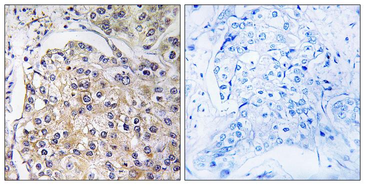 ADGRF5 / GPR116 Antibody - Peptide - + Immunohistochemistry analysis of paraffin-embedded human breast carcinoma tissue using GPR116 antibody.