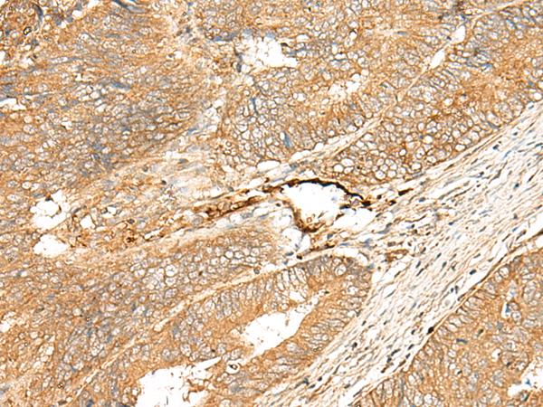 ADGRF5 / GPR116 Antibody - Immunohistochemistry of paraffin-embedded Human colorectal cancer tissue  using ADGRF5 Polyclonal Antibody at dilution of 1:40(×200)