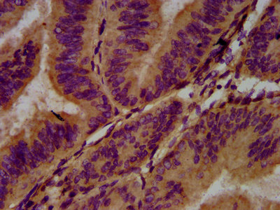 ADGRG1 / GPR56 Antibody - Immunohistochemistry Dilution at 1:400 and staining in paraffin-embedded human endometrial cancer performed on a Leica BondTM system. After dewaxing and hydration, antigen retrieval was mediated by high pressure in a citrate buffer (pH 6.0). Section was blocked with 10% normal Goat serum 30min at RT. Then primary antibody (1% BSA) was incubated at 4°C overnight. The primary is detected by a biotinylated Secondary antibody and visualized using an HRP conjugated SP system.