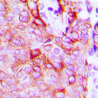 ADGRL2 / LPHN2 Antibody - Immunohistochemical analysis of LPHN2 staining in human breast cancer formalin fixed paraffin embedded tissue section. The section was pre-treated using heat mediated antigen retrieval with sodium citrate buffer (pH 6.0). The section was then incubated with the antibody at room temperature and detected using an HRP conjugated compact polymer system. DAB was used as the chromogen. The section was then counterstained with hematoxylin and mounted with DPX. w