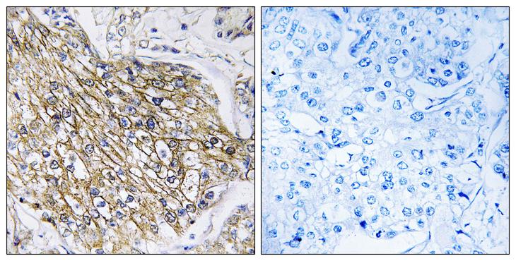 ADGRL2 / LPHN2 Antibody - Peptide - + Immunohistochemistry analysis of paraffin-embedded human breast carcinoma tissue using LPHN2 antibody.