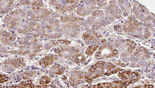 ADGRL4 / ELTD1 Antibody - 1:100 staining human liver carcinoma tissues by IHC-P. The sample was formaldehyde fixed and a heat mediated antigen retrieval step in citrate buffer was performed. The sample was then blocked and incubated with the antibody for 1.5 hours at 22°C. An HRP conjugated goat anti-rabbit antibody was used as the secondary.