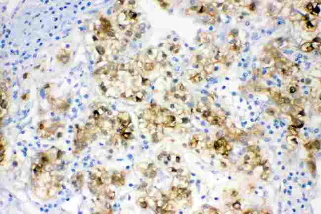 ADH1A / Alcohol Dehydrogenase Antibody - ADH1A was detected in paraffin-embedded sections of human liver cancer tissues using rabbit anti- ADH1A Antigen Affinity purified polyclonal antibody