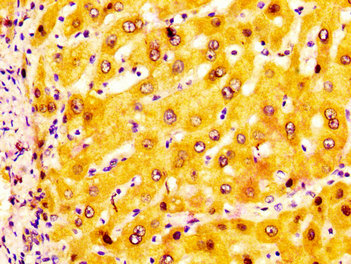 ADH1A / Alcohol Dehydrogenase Antibody - Immunohistochemistry image at a dilution of 1:200 and staining in paraffin-embedded human liver tissue performed on a Leica BondTM system. After dewaxing and hydration, antigen retrieval was mediated by high pressure in a citrate buffer (pH 6.0) . Section was blocked with 10% normal goat serum 30min at RT. Then primary antibody (1% BSA) was incubated at 4 °C overnight. The primary is detected by a biotinylated secondary antibody and visualized using an HRP conjugated SP system.