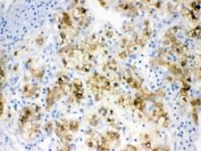 ADH1A / Alcohol Dehydrogenase Antibody - IHC testing of FFPE human liver cancer tissue with Alcohol dehydrogenase antibody at 1ug/ml. HIER: steam sections in pH6 citrate buffer for 20 min.