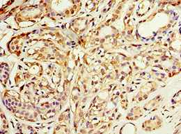 ADH1C Antibody - Immunohistochemistry of paraffin-embedded human breast cancer using antibody at 1:100 dilution.