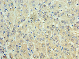 ADH1C Antibody - Immunohistochemistry of paraffin-embedded human liver cancer using antibody at 1:100 dilution.