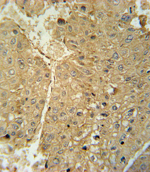 ADH1C Antibody - ADH1C Antibody immunohistochemistry of formalin-fixed and paraffin-embedded human hepatocarcinoma followed by peroxidase-conjugated secondary antibody and DAB staining.