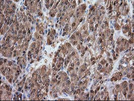 ADH2 / ADH1B Antibody - IHC of paraffin-embedded Carcinoma of Human liver tissue using anti-ADH1B mouse monoclonal antibody.