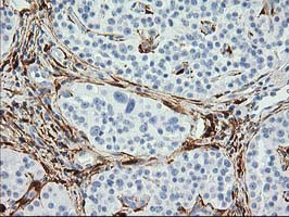 ADH2 / ADH1B Antibody - IHC of paraffin-embedded Carcinoma of Human pancreas tissue using anti-ADH1B mouse monoclonal antibody.
