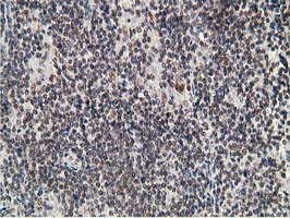 ADH2 / ADH1B Antibody - IHC of paraffin-embedded Human lymphoma tissue using anti-ADH1B mouse monoclonal antibody. (Heat-induced epitope retrieval by 10mM citric buffer, pH6.0, 100C for 10min).