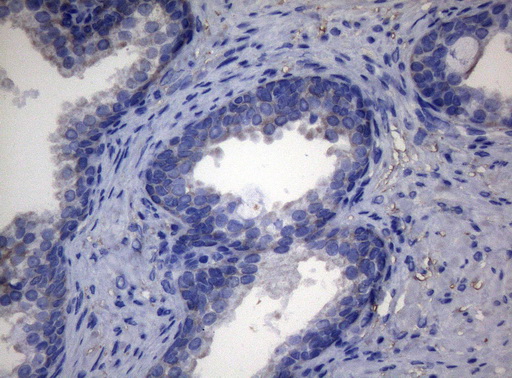 ADH5 Antibody - Immunohistochemical staining of paraffin-embedded Carcinoma of Human prostate tissue using anti-ADH5 mouse monoclonal antibody. (Heat-induced epitope retrieval by 1mM EDTA in 10mM Tris buffer. (pH8.5) at 120°C for 3 min. (1:150)