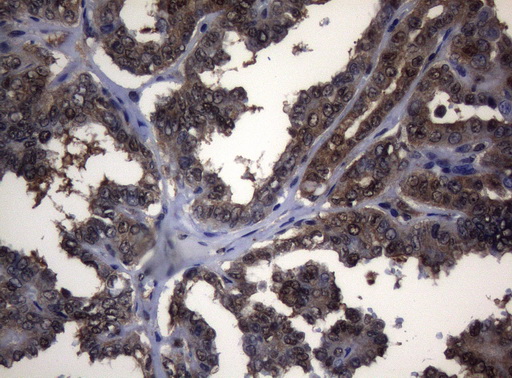 ADH5 Antibody - Immunohistochemical staining of paraffin-embedded Carcinoma of Human thyroid tissue using anti-ADH5 mouse monoclonal antibody. (Heat-induced epitope retrieval by 1mM EDTA in 10mM Tris buffer. (pH8.5) at 120°C for 3 min. (1:150)
