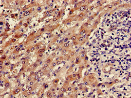 ADH5 Antibody - Immunohistochemistry of paraffin-embedded human liver cancer using ADH5 Antibody at dilution of 1:100