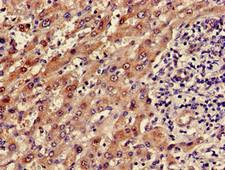 ADH5 Antibody - Immunohistochemistry of paraffin-embedded human liver cancer using ADH5 Antibody at dilution of 1:100