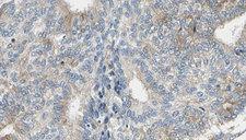 ADH5 Antibody - 1:100 staining human prostate tissue by IHC-P. The sample was formaldehyde fixed and a heat mediated antigen retrieval step in citrate buffer was performed. The sample was then blocked and incubated with the antibody for 1.5 hours at 22°C. An HRP conjugated goat anti-rabbit antibody was used as the secondary.