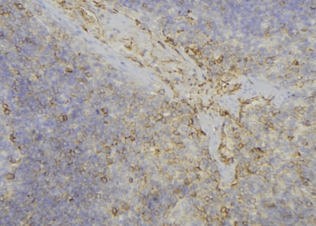 ADH6 Antibody - 1:100 staining human lymph node tissue by IHC-P. The sample was formaldehyde fixed and a heat mediated antigen retrieval step in citrate buffer was performed. The sample was then blocked and incubated with the antibody for 1.5 hours at 22°C. An HRP conjugated goat anti-rabbit antibody was used as the secondary.