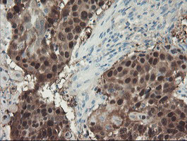 ADH7 Antibody - IHC of paraffin-embedded Carcinoma of Human lung tissue using anti-ADH7 mouse monoclonal antibody. At a dilution of 1:150.