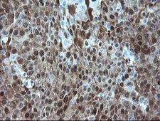 ADH7 Antibody - IHC of paraffin-embedded Carcinoma of Human lung tissue using anti-ADH7 mouse monoclonal antibody.