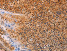 ADHFE1 Antibody - Immunohistochemistry of paraffin-embedded Human lung cancer using ADHFE1 Polyclonal Antibody at dilution of 1:30.