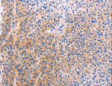 ADHFE1 Antibody - Immunohistochemistry of paraffin-embedded Human cervical cancer using ADHFE1 Polyclonal Antibody at dilution of 1:60.