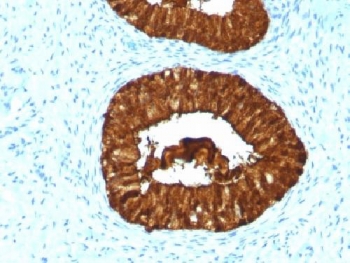 Adipokines / Adiponectin Antibody - IHC testing of FFPE human cervical carcinoma with MAML3 antibody (clone MAML3/1303). Staining of FFPE tissue requires boiling sections in 10mM Tris with 1mM EDTA, pH9, for 10-20 min followed by cooling at RT for 20 min.