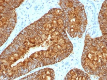 Adipokines / Adiponectin Antibody - IHC testing of FFPE human colon carcinoma with MAML3 antibody (clone MAML3/1303). Staining of FFPE tissue requires boiling sections in 10mM Tris with 1mM EDTA, pH9, for 10-20 min followed by cooling at RT for 20 min.