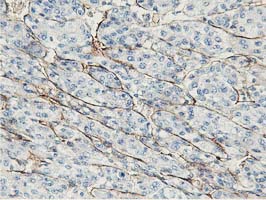 Adiponectin Antibody - IHC of paraffin-embedded Carcinoma of Human liver tissue using anti-ADIPOQ mouse monoclonal antibody. (Heat-induced epitope retrieval by 10mM citric buffer, pH6.0, 100C for 10min).
