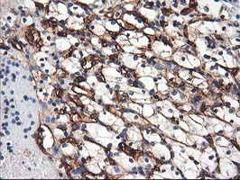 Adiponectin Antibody - IHC of paraffin-embedded Carcinoma of Human kidney tissue using anti-ADIPOQ mouse monoclonal antibody. (Heat-induced epitope retrieval by 10mM citric buffer, pH6.0, 100C for 10min).
