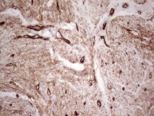 Adiponectin Antibody - Immunohistochemical staining of paraffin-embedded Adenocarcinoma of Human endometrium tissue using anti-ADIPOQ mouse monoclonal antibody. (Heat-induced epitope retrieval by 1 mM EDTA in 10mM Tris, pH8.5, 120C for 3min,