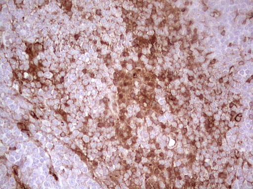 Adiponectin Antibody - Immunohistochemical staining of paraffin-embedded Human lymphoma tissue using anti-ADIPOQ mouse monoclonal antibody. (Heat-induced epitope retrieval by 1 mM EDTA in 10mM Tris, pH8.5, 120C for 3min,
