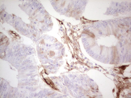 Adiponectin Antibody - Immunohistochemical staining of paraffin-embedded Adenocarcinoma of Human colon tissue using anti-ADIPOQ mouse monoclonal antibody. (Heat-induced epitope retrieval by 1 mM EDTA in 10mM Tris, pH8.5, 120C for 3min,